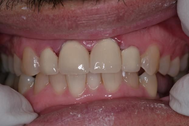 A recent cosmetic dentist job in the Bulverde, TX area
